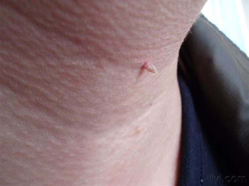 寻常疣--门诊照片