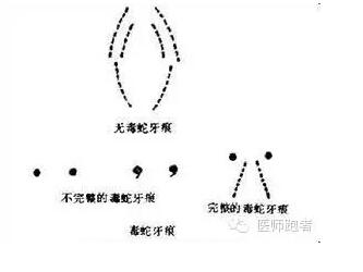 毒蛇咬伤通常见两个或一个或三个比较大而深的牙痕