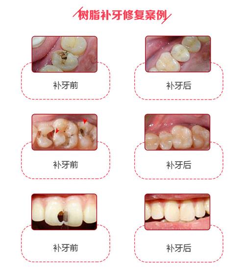 医保定点 全进口3m纳米树脂补牙 治疗龋齿牙痛蛀牙/ 效果自然 缺损