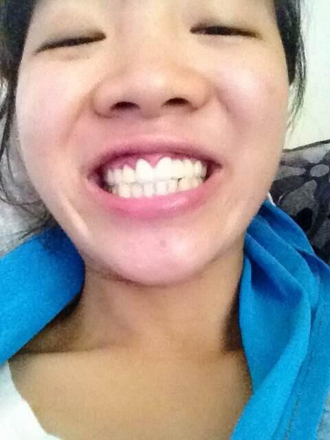 问:请问这假牙是不是非常容易被看出是假牙啊?