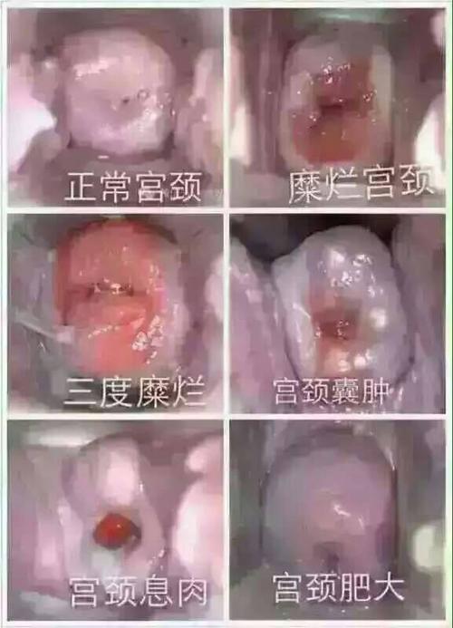 宫颈炎和宫颈糜烂是怎么回事