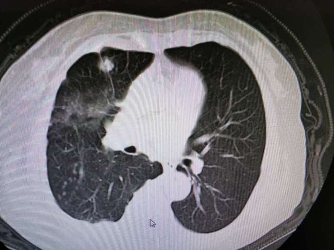 空洞型肺结核治愈好后抽烟会变肺癌吗