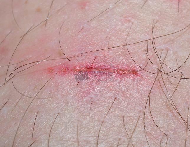 皮肤上的伤口