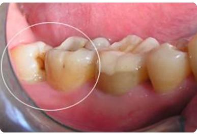 智齿拔除  立即咨询 ■图片展示   虽然智齿贡献的咀嚼能力对于现代人