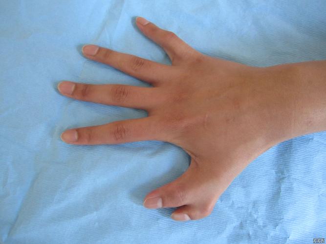 六指畸形一例 直接上图