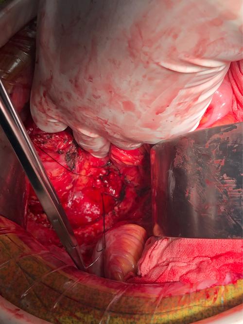 卵巢癌第二次复发再次手术,距首次手术近10年