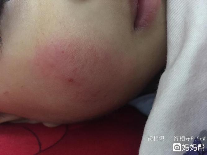 宝宝的脸是冻疙瘩吗?