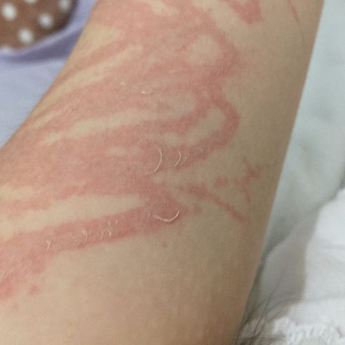 被水母蛰十天了,面积也有点大,会留疤吗,红色什么多久才能消,还能恢复