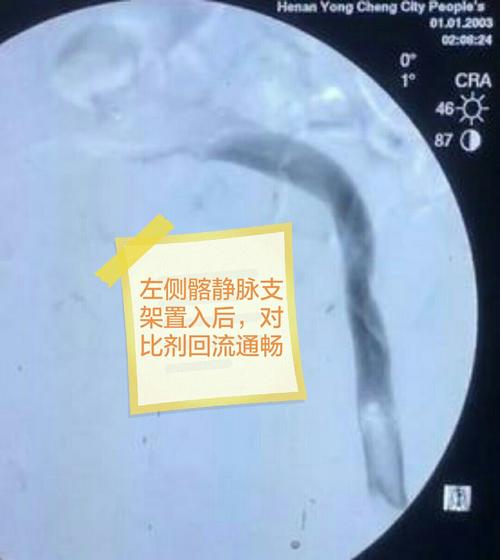 髂静脉压迫综合征