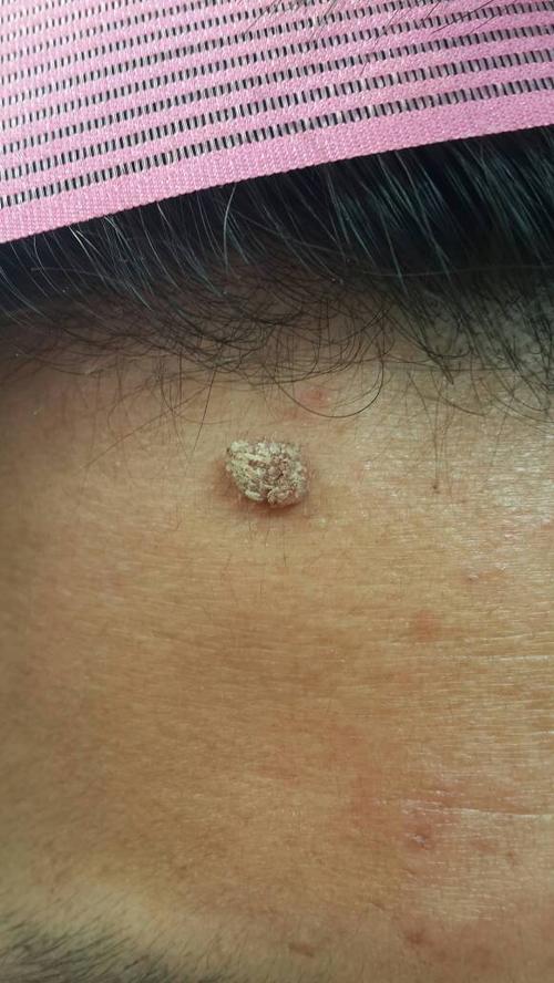 如图,1年多了,起初是个痘痘,然后慢慢的就这样了