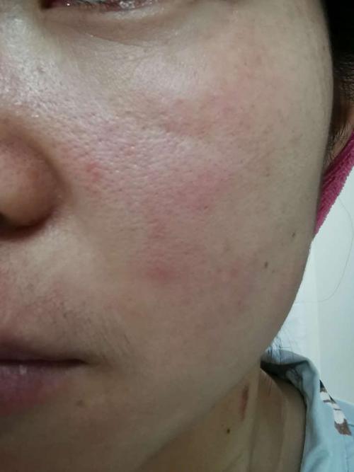 脂溢性皮炎和玫瑰痤疮的区别?