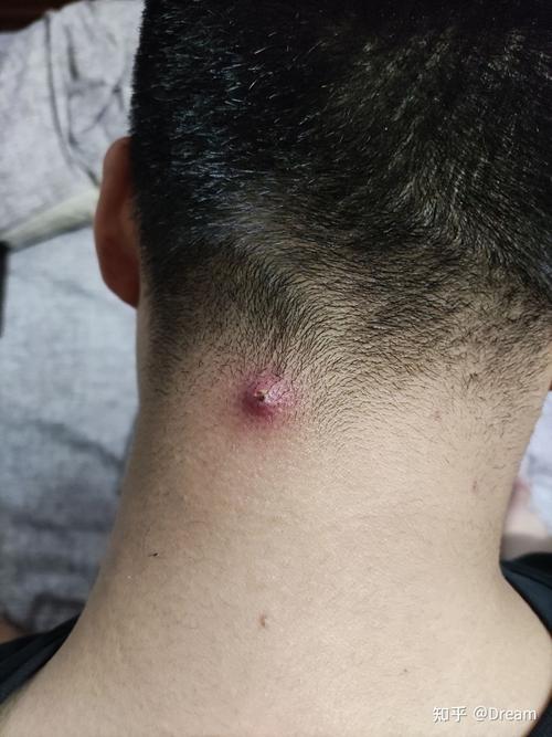 我长疖子的时候治疗的时候全过程