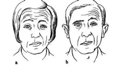 中风:中枢性面神经麻痹——核上性损伤眼裂以下单侧支配——口角歪斜