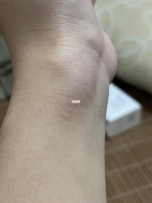 手腕脉搏处鼓了个小包,是腱鞘囊肿吗?