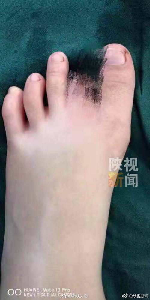 脚趾移植当手指用 医生移花接木救孩子