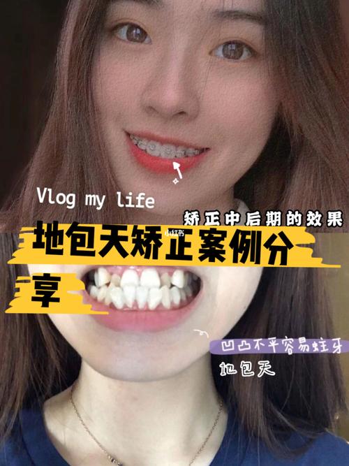 成都地包天矫正分享案例07