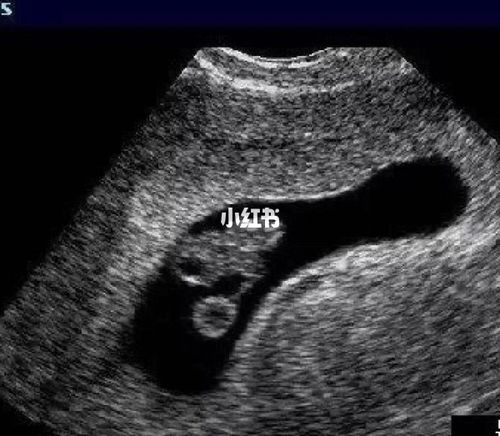 7-8周超声表现_nt检查_运动_母婴_孕产经验
