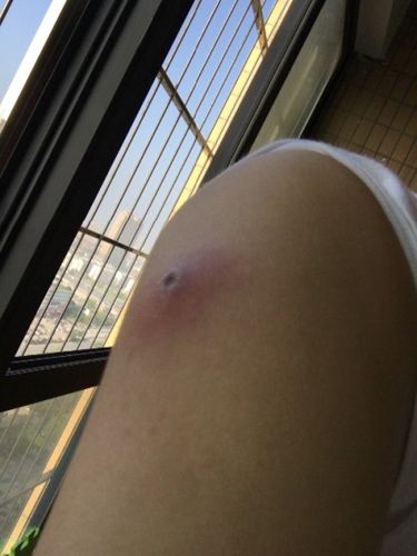 手臂长了疮,超级痛,几天了,前几天以为是一般的热毒疮