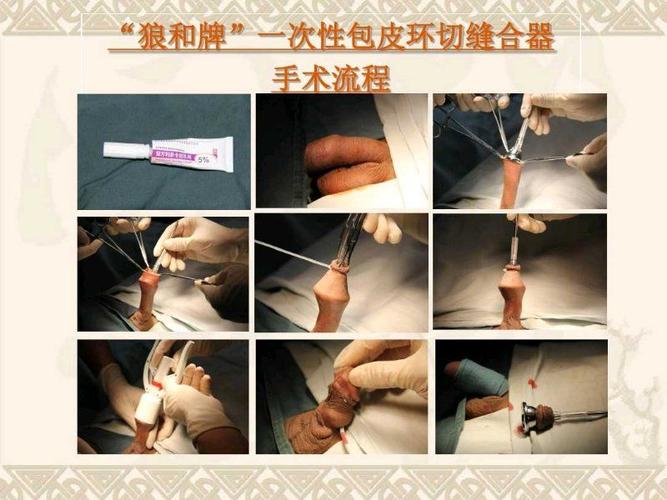 包皮过长和包茎