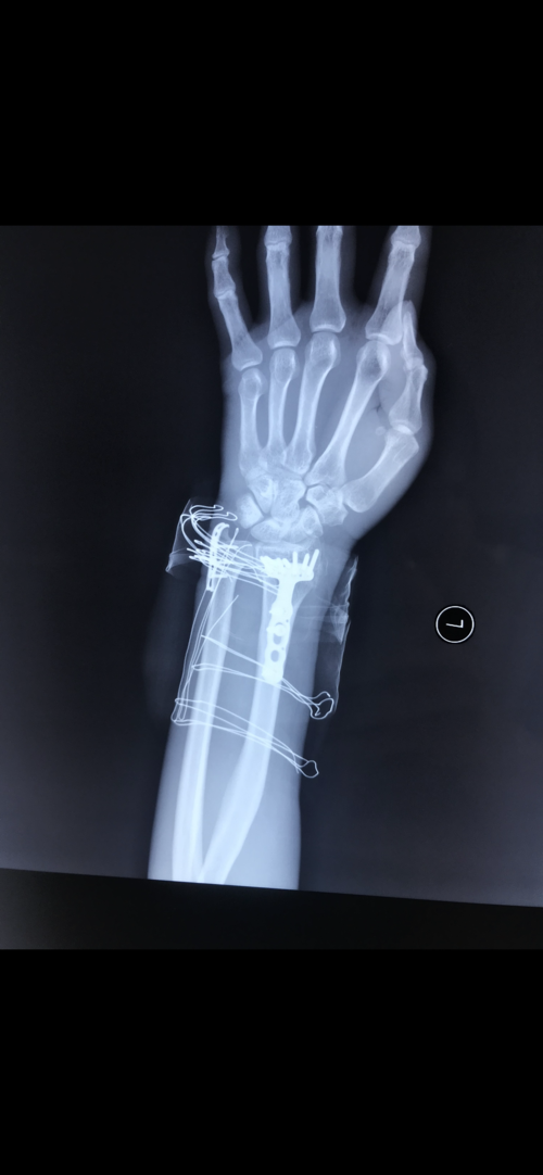 左桡骨远端骨折伴尺骨茎突骨折手术一例