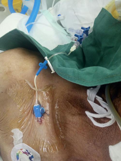 锁骨下中心静脉置管.