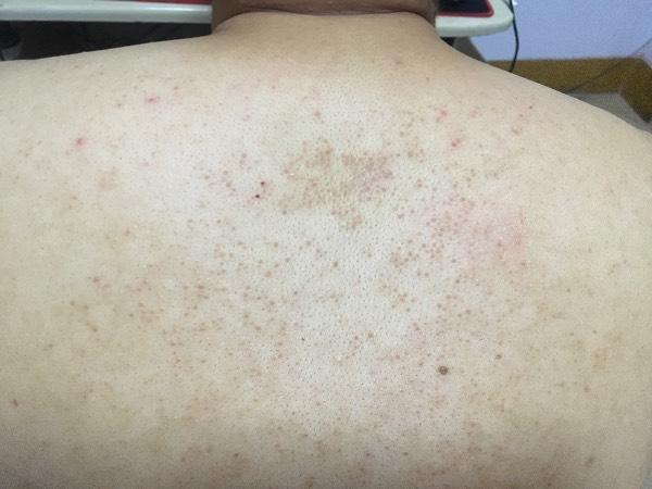 后背这个是什么?毛孔角化症么?