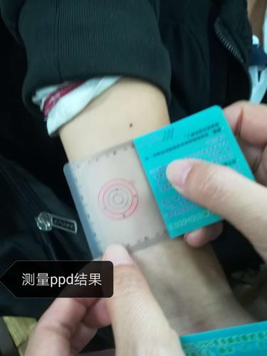 结核菌素试验(ppd)操作过程中全过程