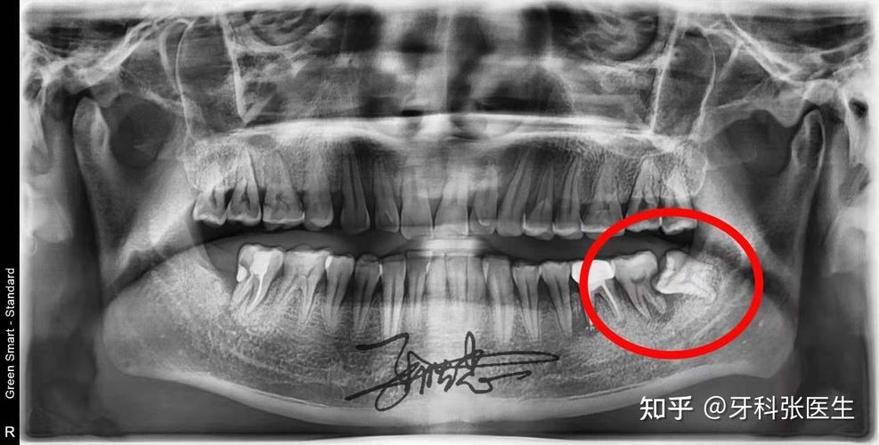 拔智齿伤神经吗?