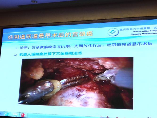 重庆医大附一唐均英 达芬奇机器人在困难宫颈癌手术中