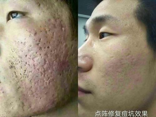 点阵激光解决妊娠纹及膨胀纹