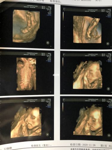 四维一次过,能看出男宝女宝吗?_女宝_母婴_孕产经验