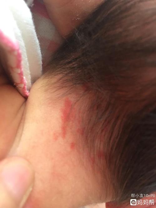 宝宝这脖子上长的胎记还是血管瘤