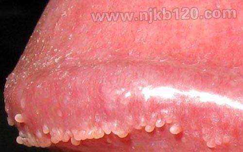 尖锐湿疣与阴茎珍珠状丘疹的鉴别方法