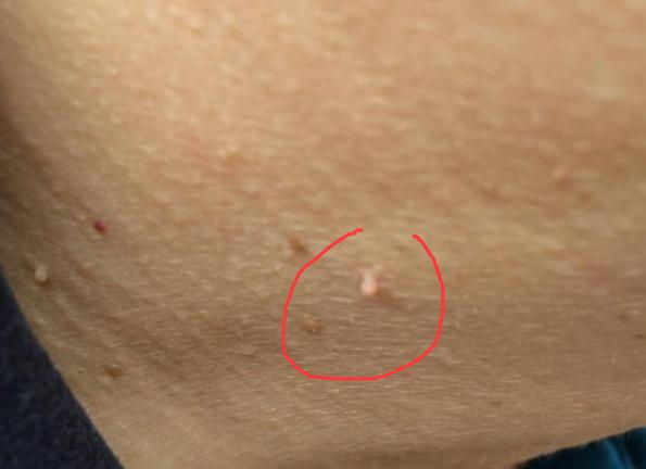 好些"小肉球",这些"肉球"其实也不痛不痒,只是有些影响皮肤外在的美观