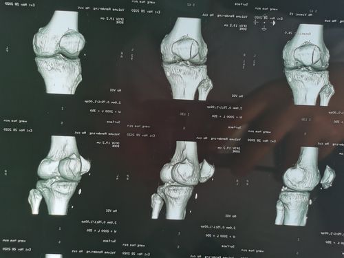 微创治疗髌骨骨折