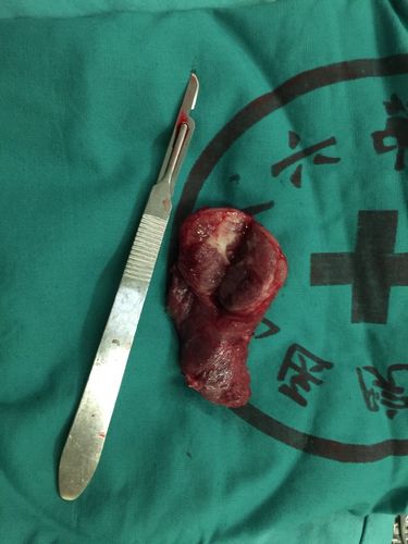 男,50岁,一侧结甲并腺瘤,一侧滤泡性肿瘤