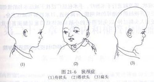 发病率男:女为2:1.正常情况下,婴儿前半年平均每个月头围增长1.