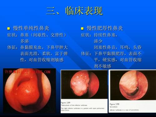 性鼻炎 症状:鼻塞(间歇性,交替性) 多涕 体征:鼻黏膜充血,下鼻甲肿大