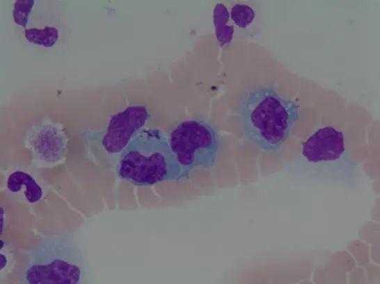 按照惯例,遇到这种患者我们就是涂片镜检,人工计数.