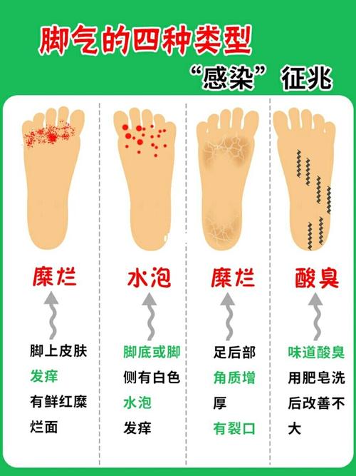 脚#气四种类型的78感染征兆7878_脚气_维维怎么