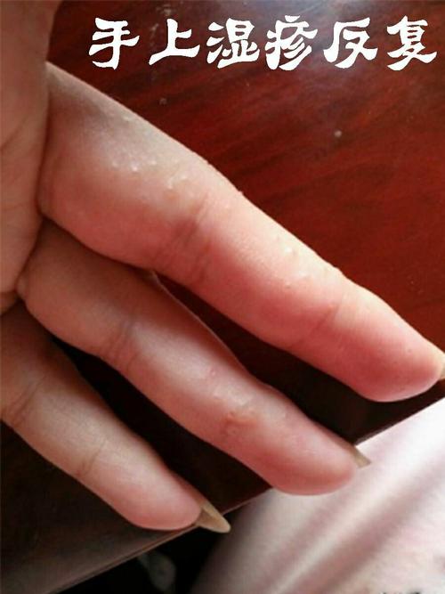 湿疹_草本_夏天去哪玩_药膏_医疗健康_医疗药品