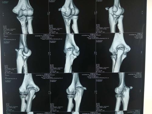 尺骨鹰嘴撕脱性骨折手术带线锚钉内固定