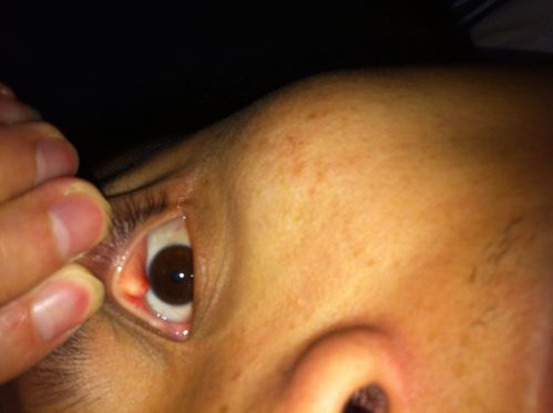 请问以下图中是麦粒肿还是霰粒肿?该如何治疗?