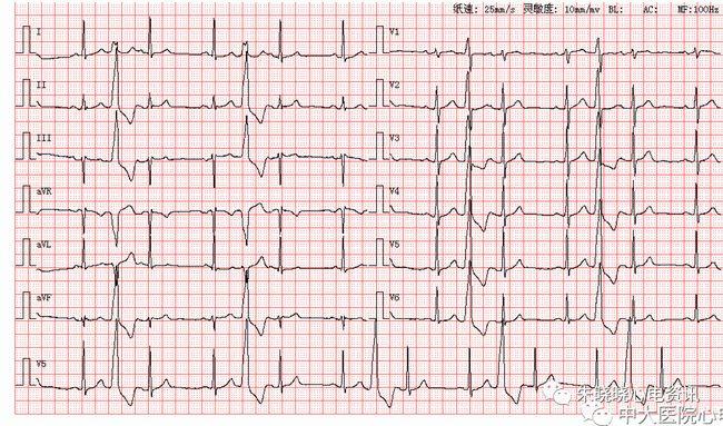 每日读图|第1491期 间位室性早搏(呈三联律)|心电图