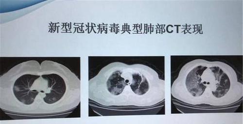 新冠肺炎感染后,患者的肺是什么样的?专家:这种最可怕