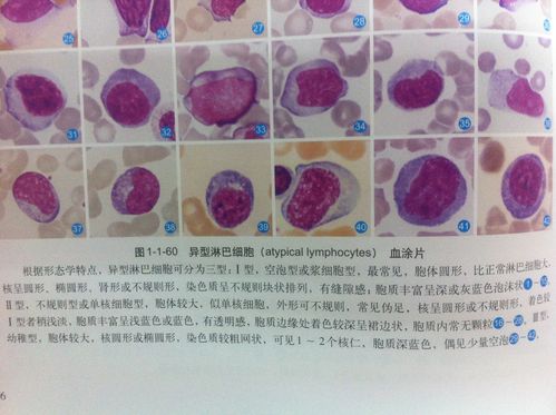 求异型淋巴细胞三种类型的多组图片及解析