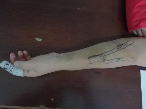 窃血内瘘的处理 尹丰闫永刚