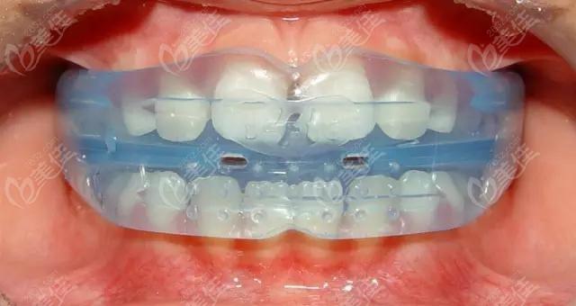 儿童罗慕矫正器