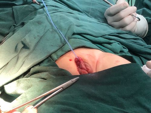 尿道下裂,阴囊转位手术