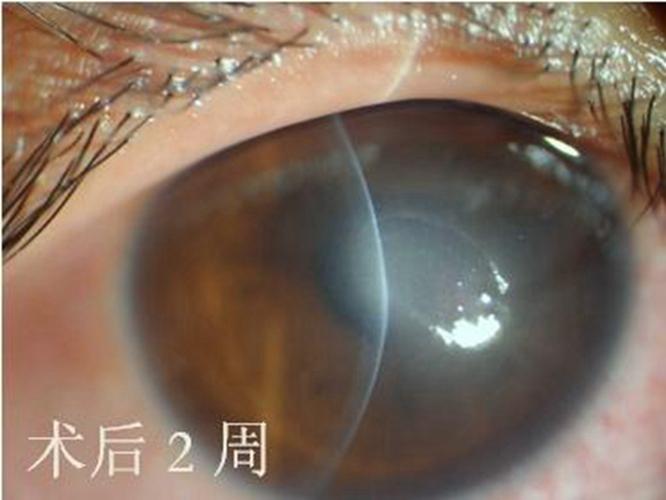 过敏性结膜炎